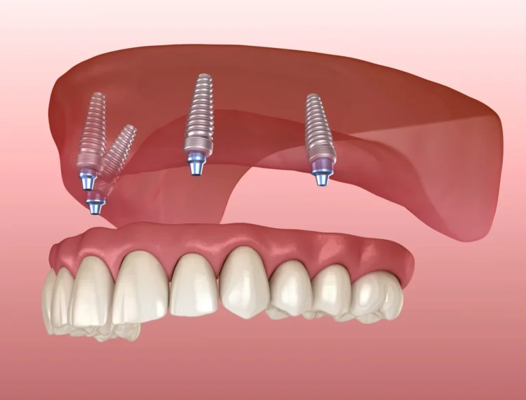 Guide to Full Mouth Dental Implants