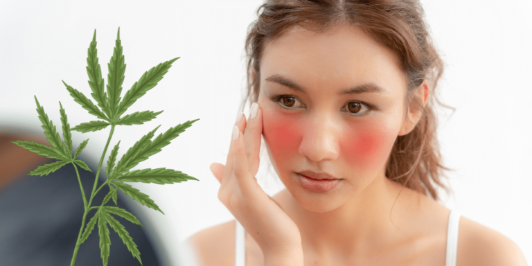 How CBD Day Cream Helps With Rosacea and Inflammation