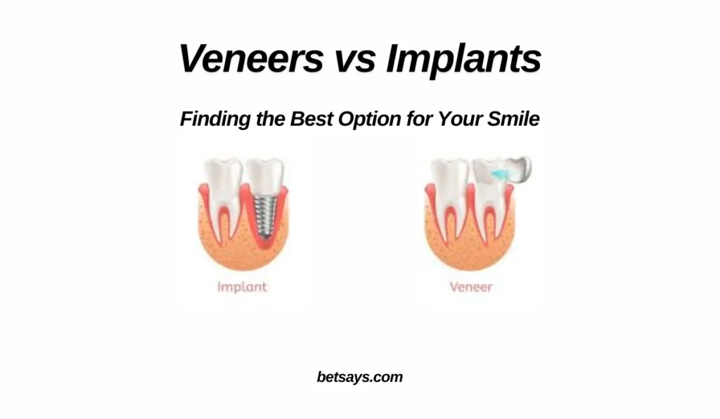 Veneers vs Implants