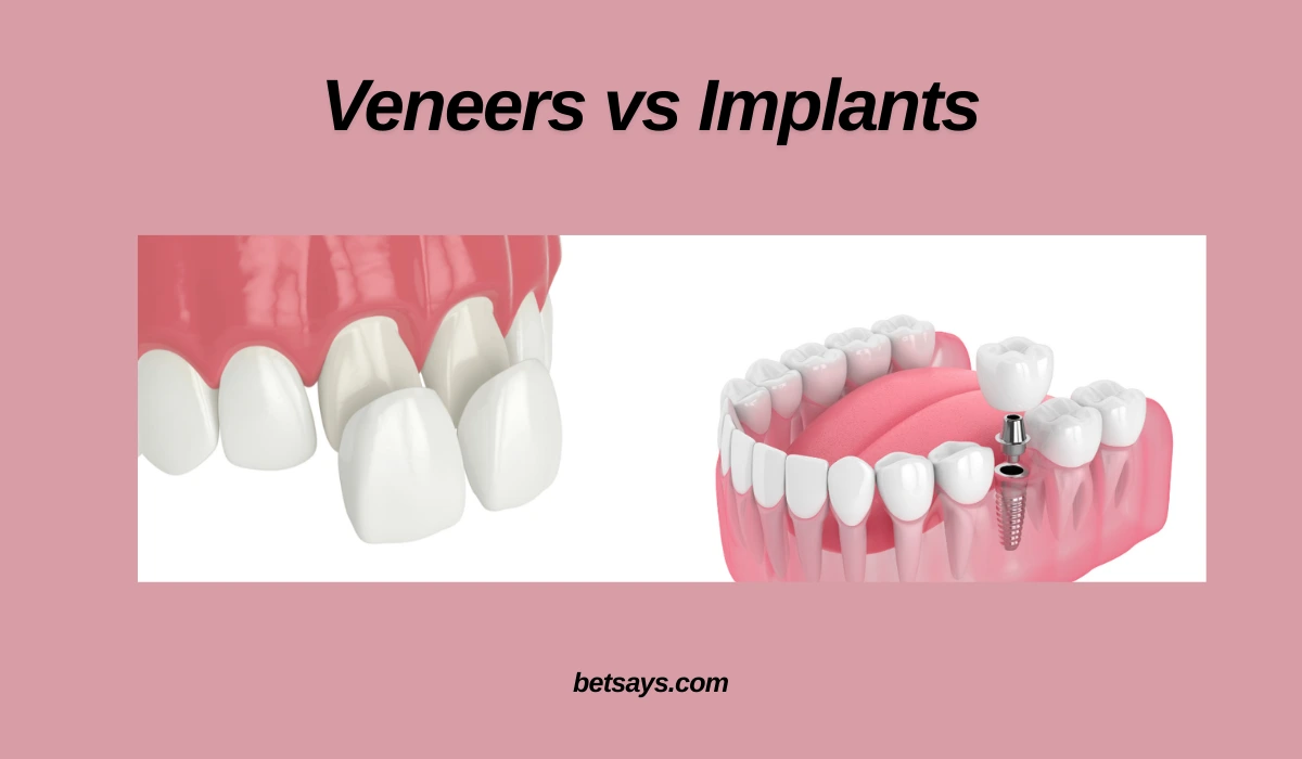 Veneers vs Implants