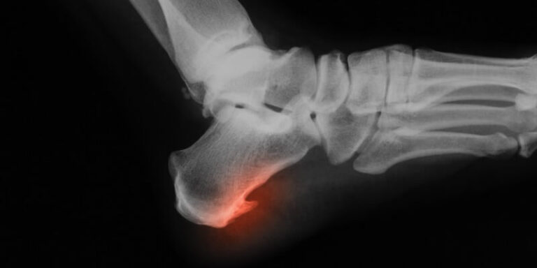 3 Types of Bone Spur Treatments